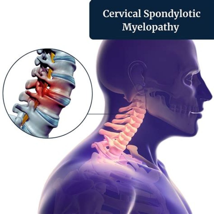 Is cervical spondylosis with myelopathy serious?