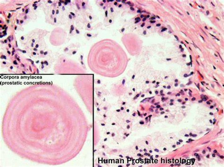 Is corpora amylacea normal in prostate?