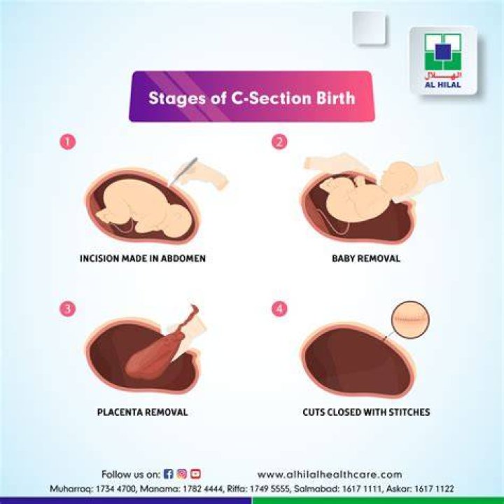 Is elective Cesarean safer than natural birth?