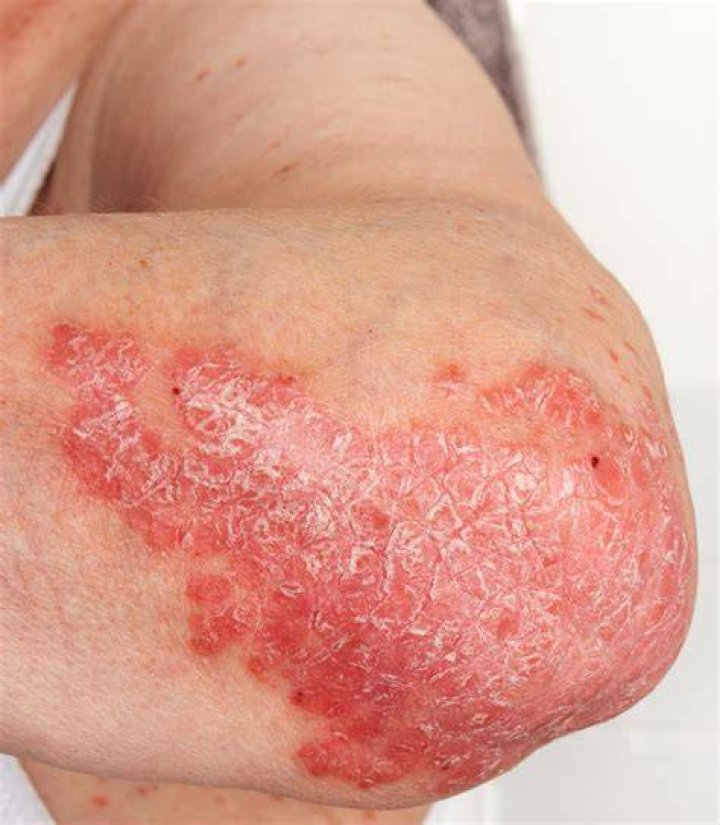Is erythroderma life threatening?
