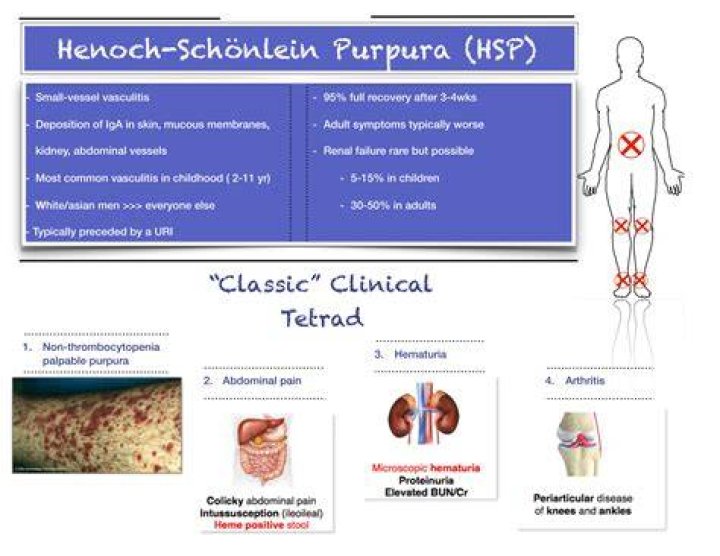 Is Henoch Schonlein purpura palpable?