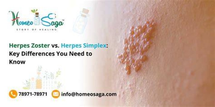 Is herpes and herpes zoster the same?