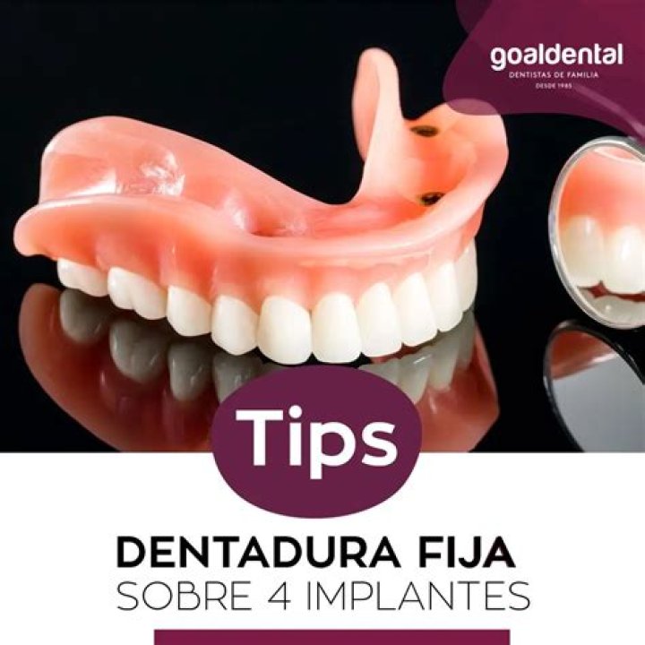 O que e dentadura de encaixe sobre implantes?