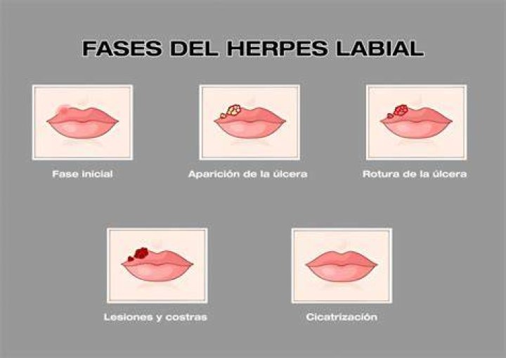 Que color son las ampollas del herpes?