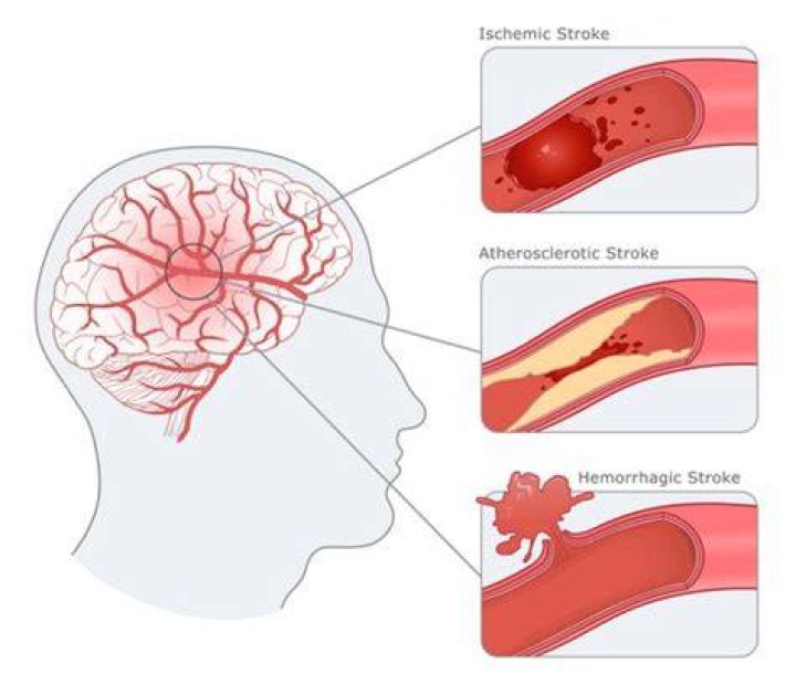 What are acute ischemic strokes?