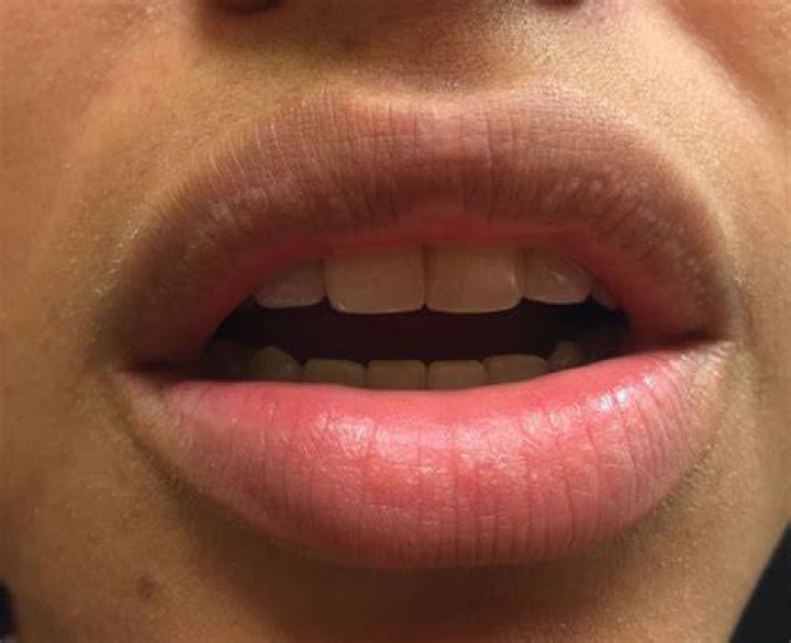 What are small blisters on lips?