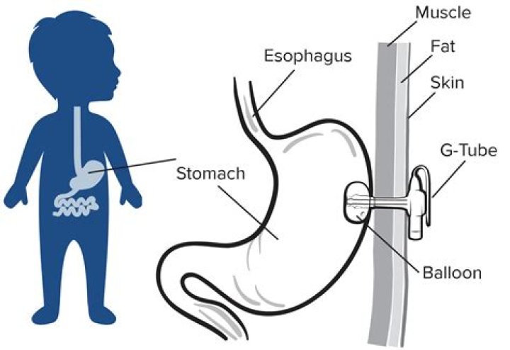 What are the complications of gastrostomy feeding?
