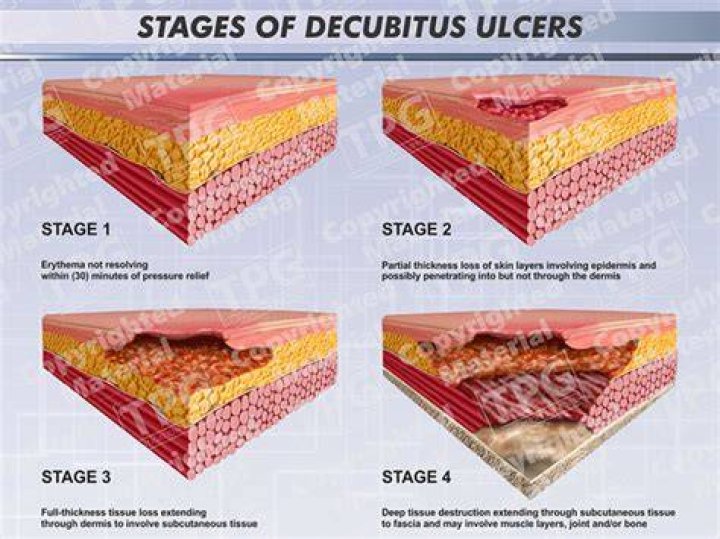 What are the four stages of decubitus ulcers?