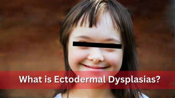 What are the symptoms of ectodermal dysplasia?