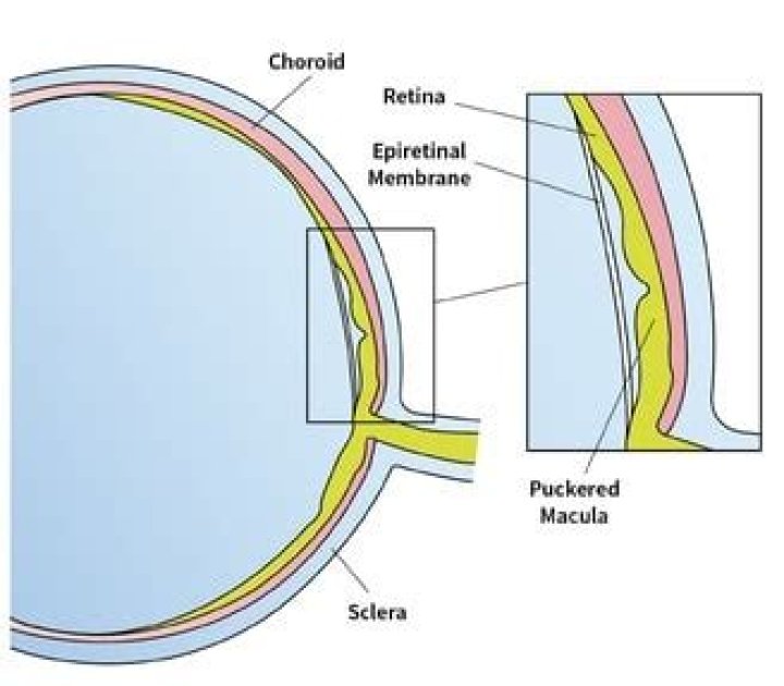 What causes an epiretinal membrane to form?