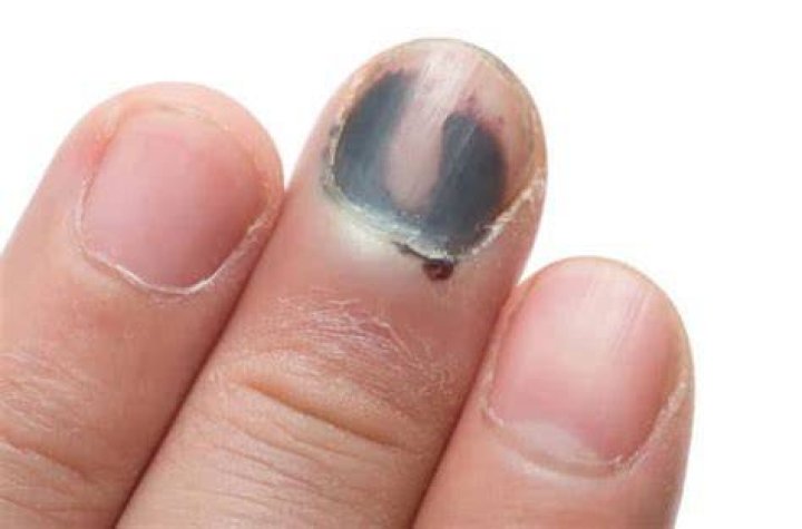 What causes dark colored fingernails?