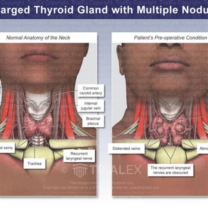 What causes enlarged veins in the neck?