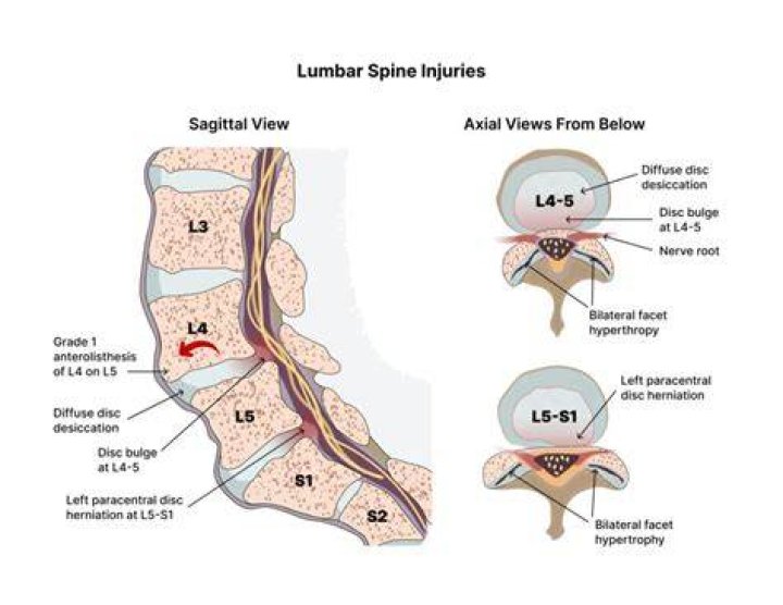 What causes limbus vertebra?
