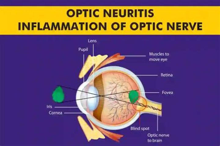 What causes poor blood flow to the optic nerve?
