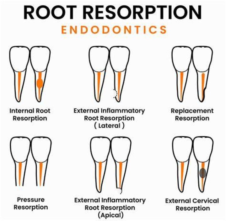 What causes root resorption in teeth?