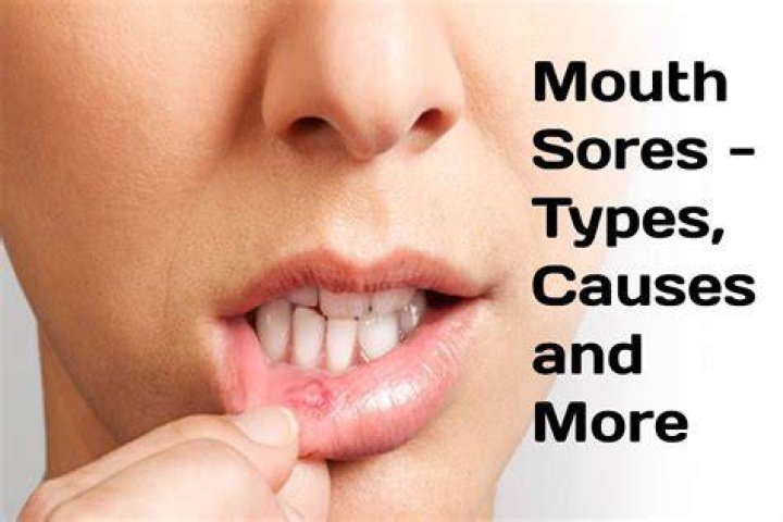 What causes sores around the mouth?