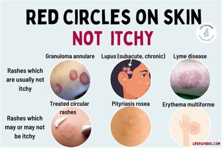 What does a red circle rash mean?