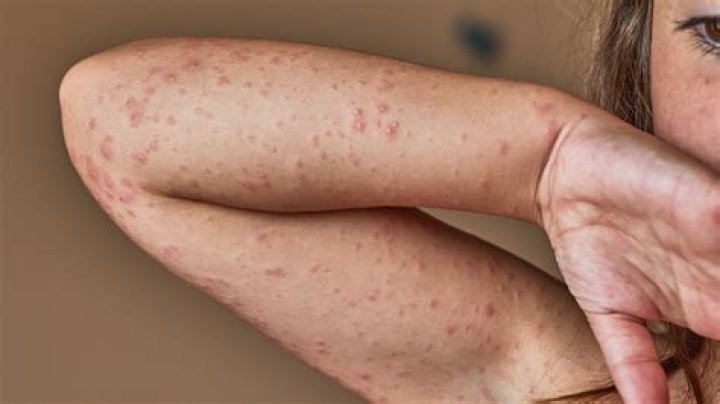 What does an antibiotic skin rash look like?