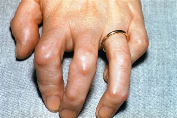 What does an arthritis bump look like?