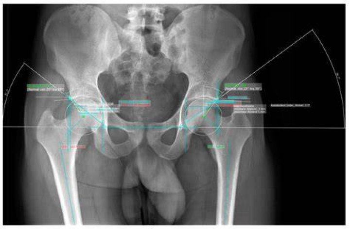 What does hip and pelvis X-ray show?