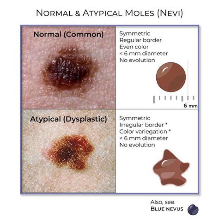 What does moderately dysplastic mean?