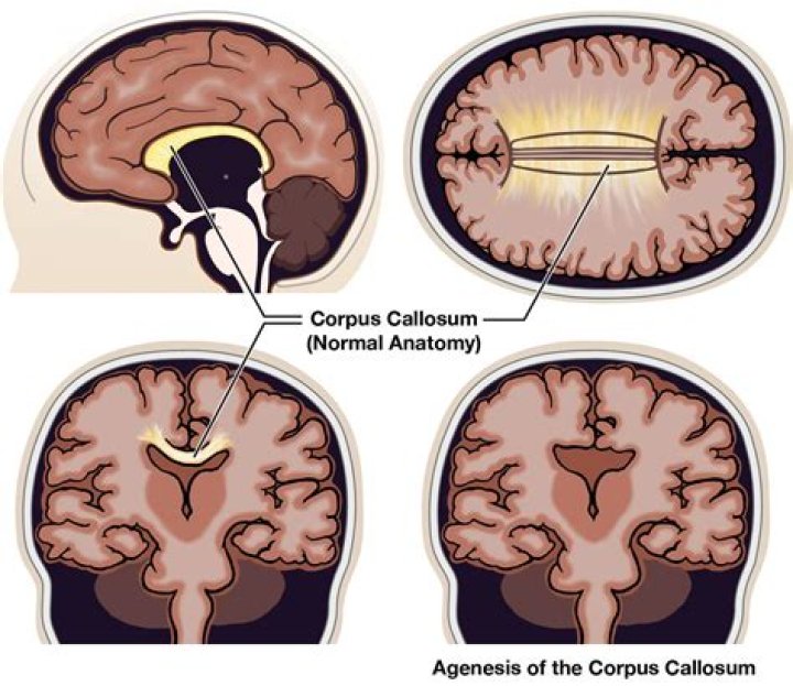 What does Splenium of corpus callosum mean?