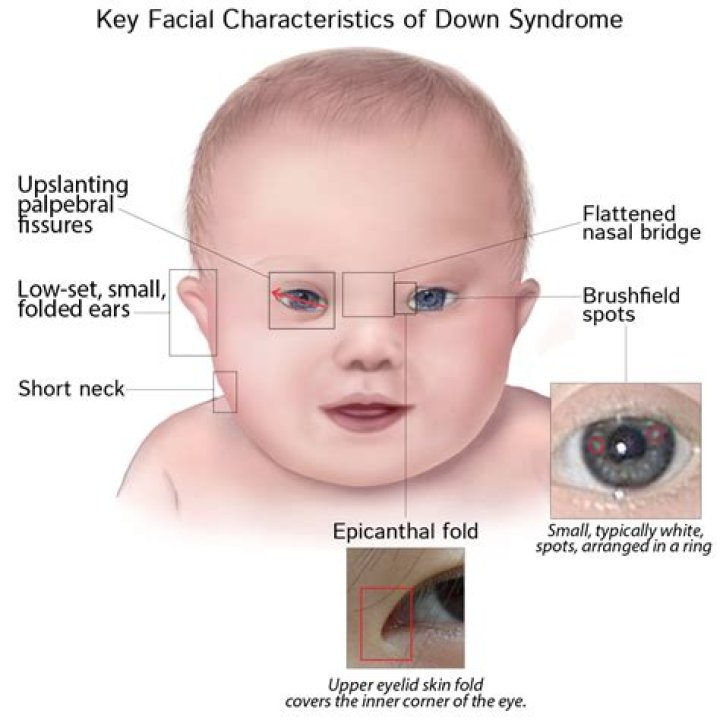 What facial features describe Down syndrome?