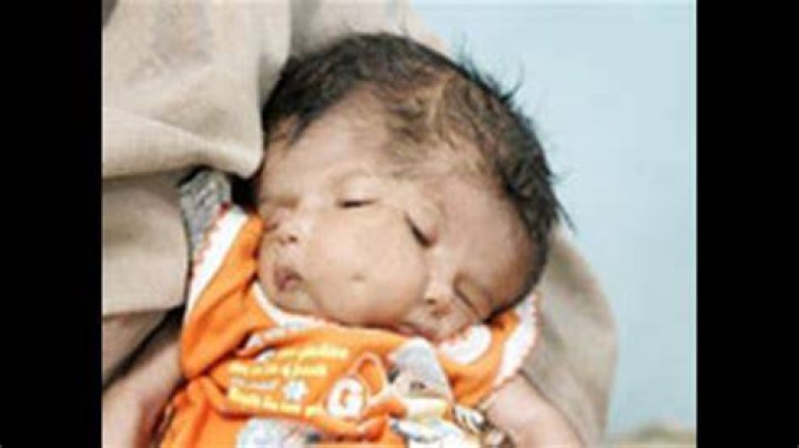 What Happened to baby with 2 faces?