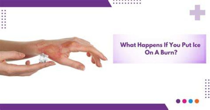 What if you put ice on a burn?