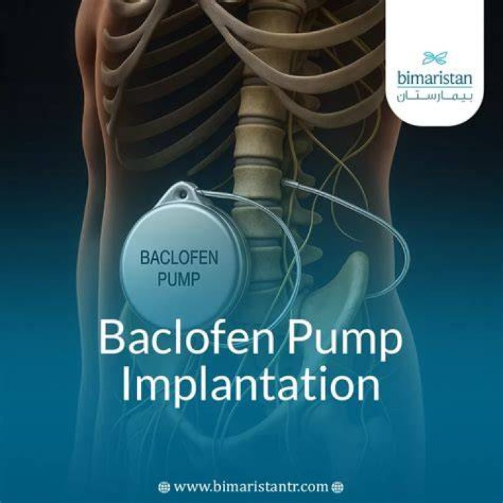 What is a baclofen pump and how does it work?