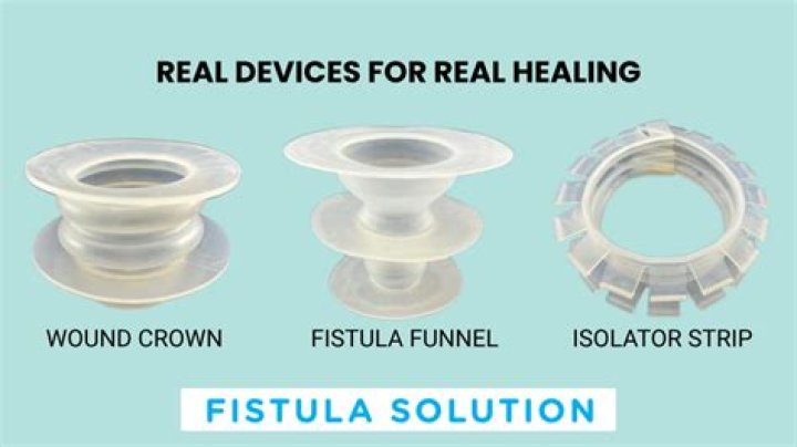 What is a fistula plug made of?