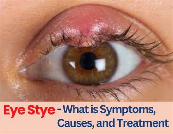What is a stye usually caused by?