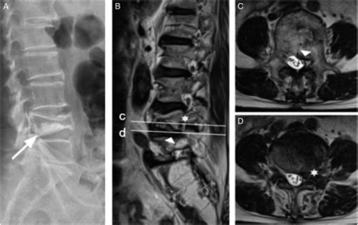 What is a wedge deformity of the spine?