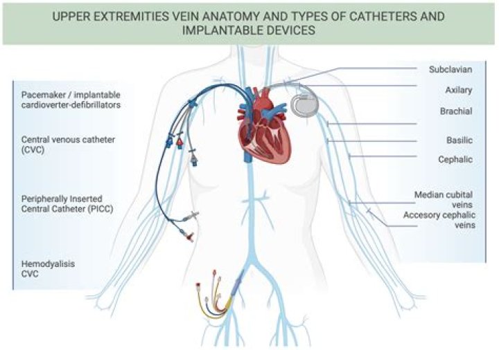 What is an Rij catheter?