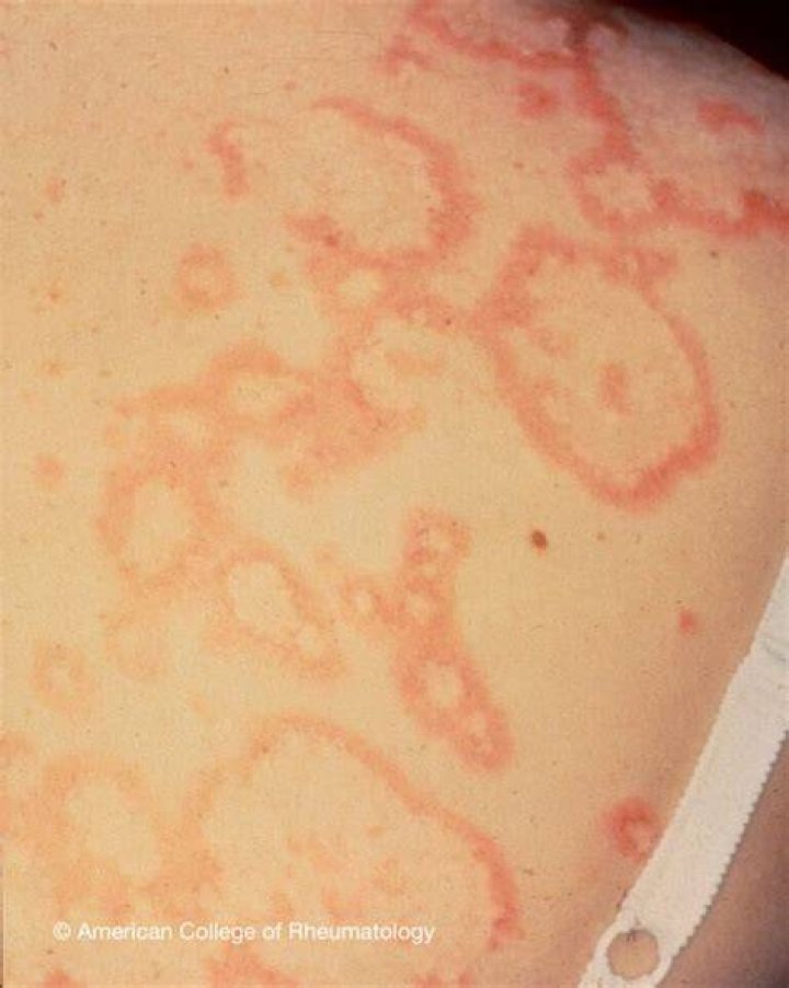 What is central clearing rash?