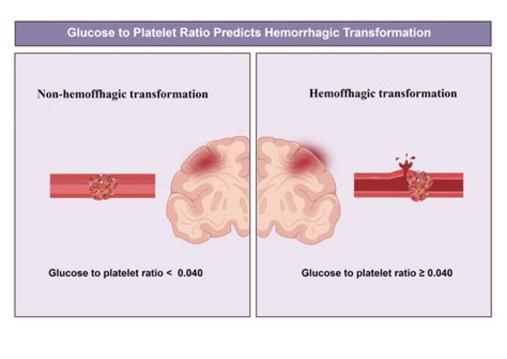 What is hemorrhagic conversion?