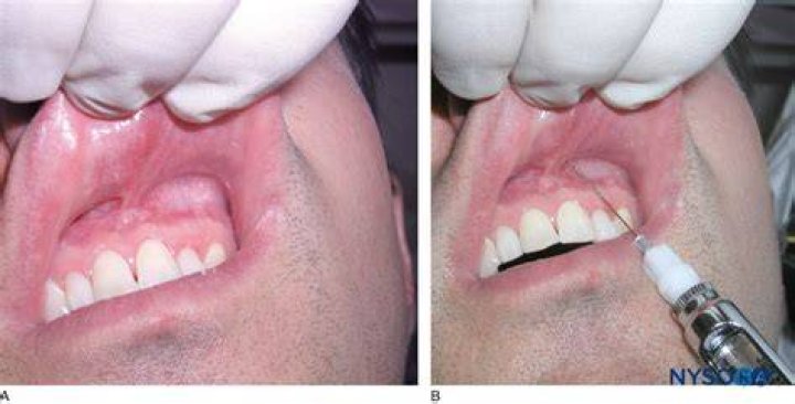 What is infiltrative anesthesia?