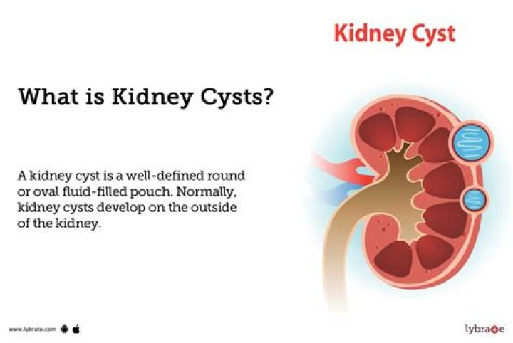 What is meant by cortical cyst in left kidney?