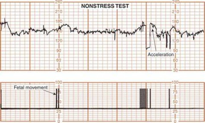 What is non-reassuring fetal status?