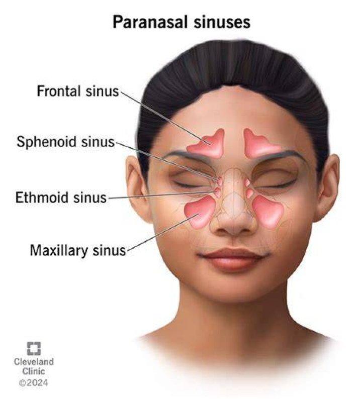 What is Parasinus?