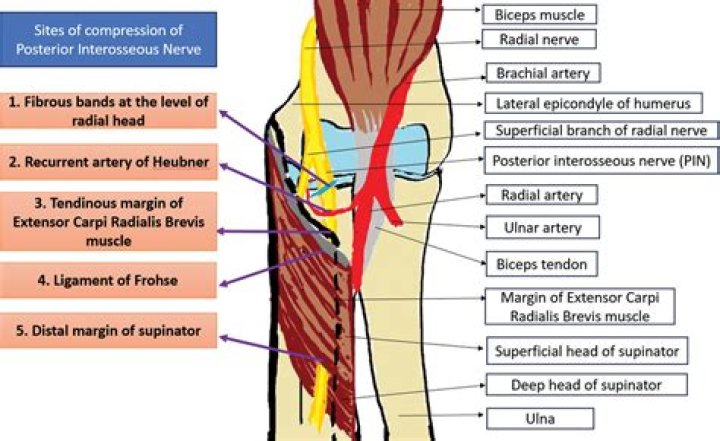 What is the CPT code for a posterior interosseous nerve Neurectomy?