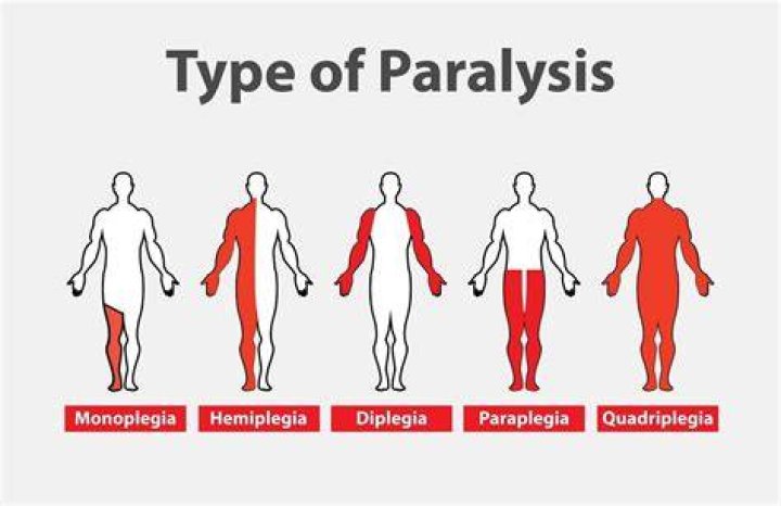 What is the difference between hemiplegia paraplegia and quadriplegia?