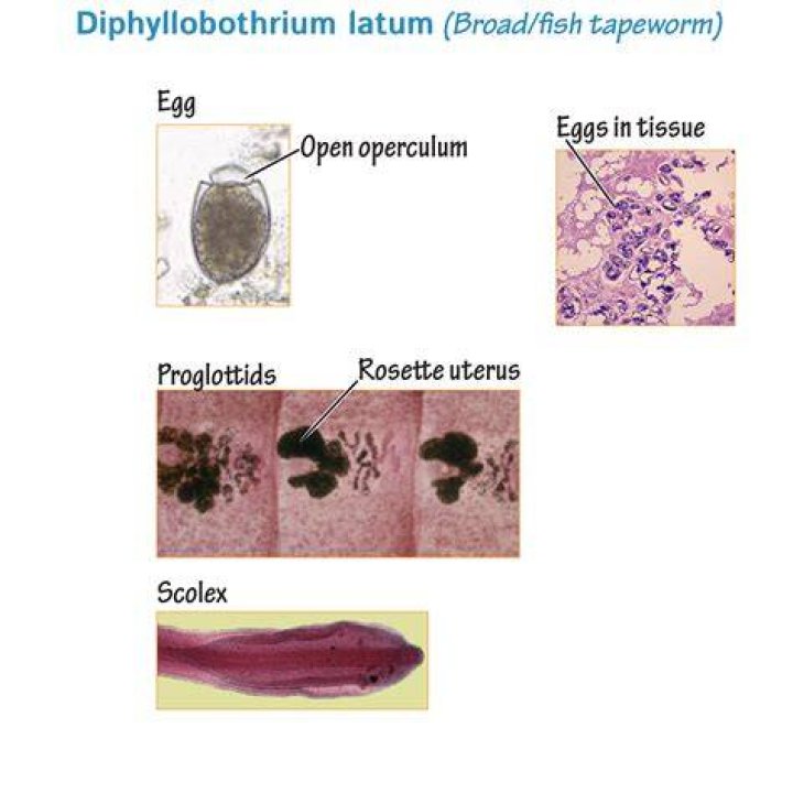 What is the distinguishing features of Diphyllobothrium Latum?