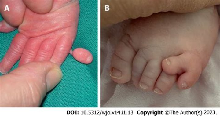 What is the meaning of Syndactylism?