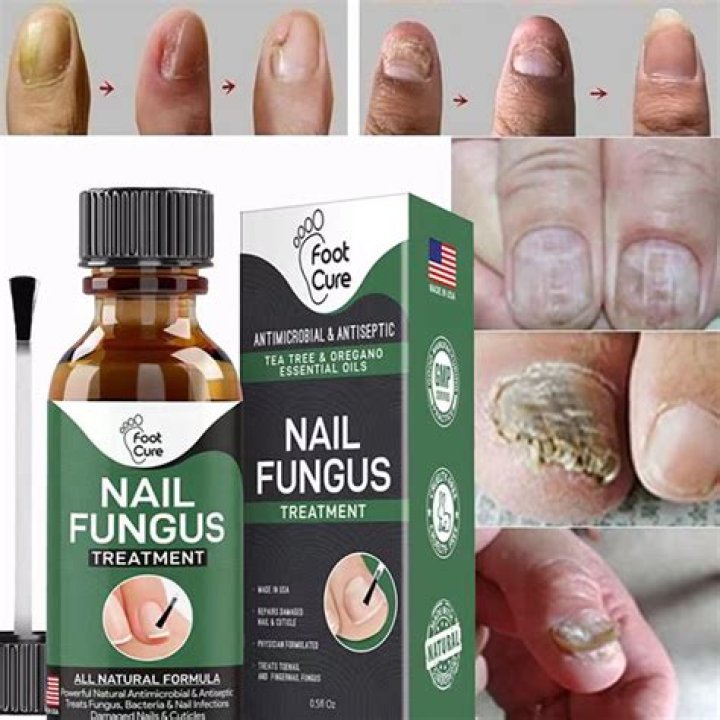 What is the most effective treatment for toenail fungus UK?