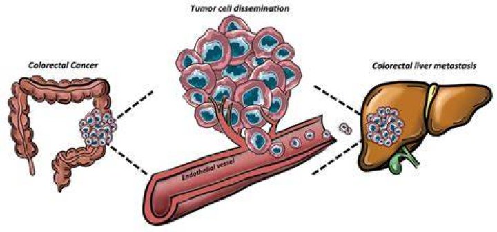What is the prognosis for colon cancer metastasis to the liver?