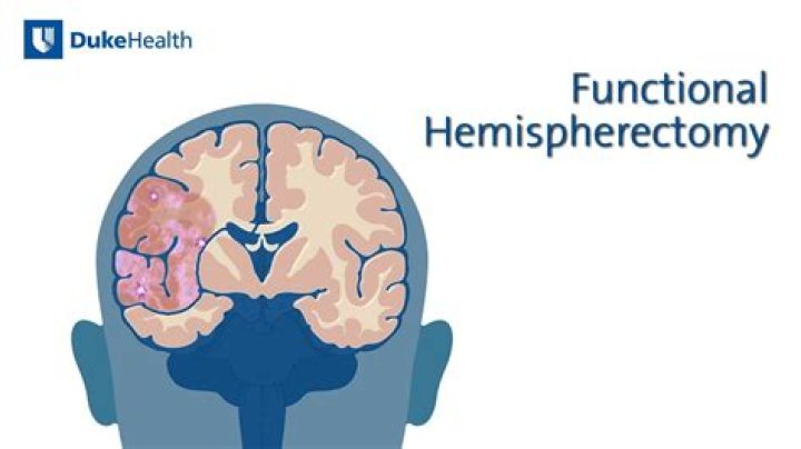 What is the survival rate of a hemispherectomy?