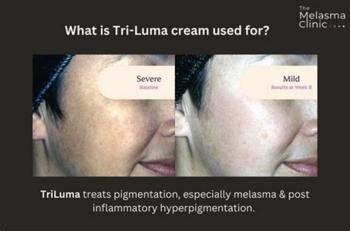 What is Tri-Luma cream good for?