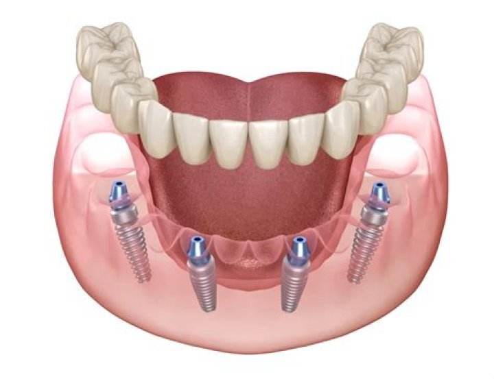 What sizes do Mentor implants come in?