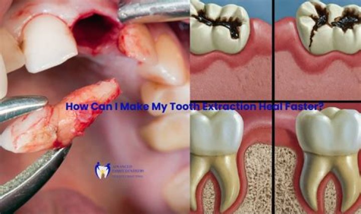 What to expect after having 2 teeth pulled?